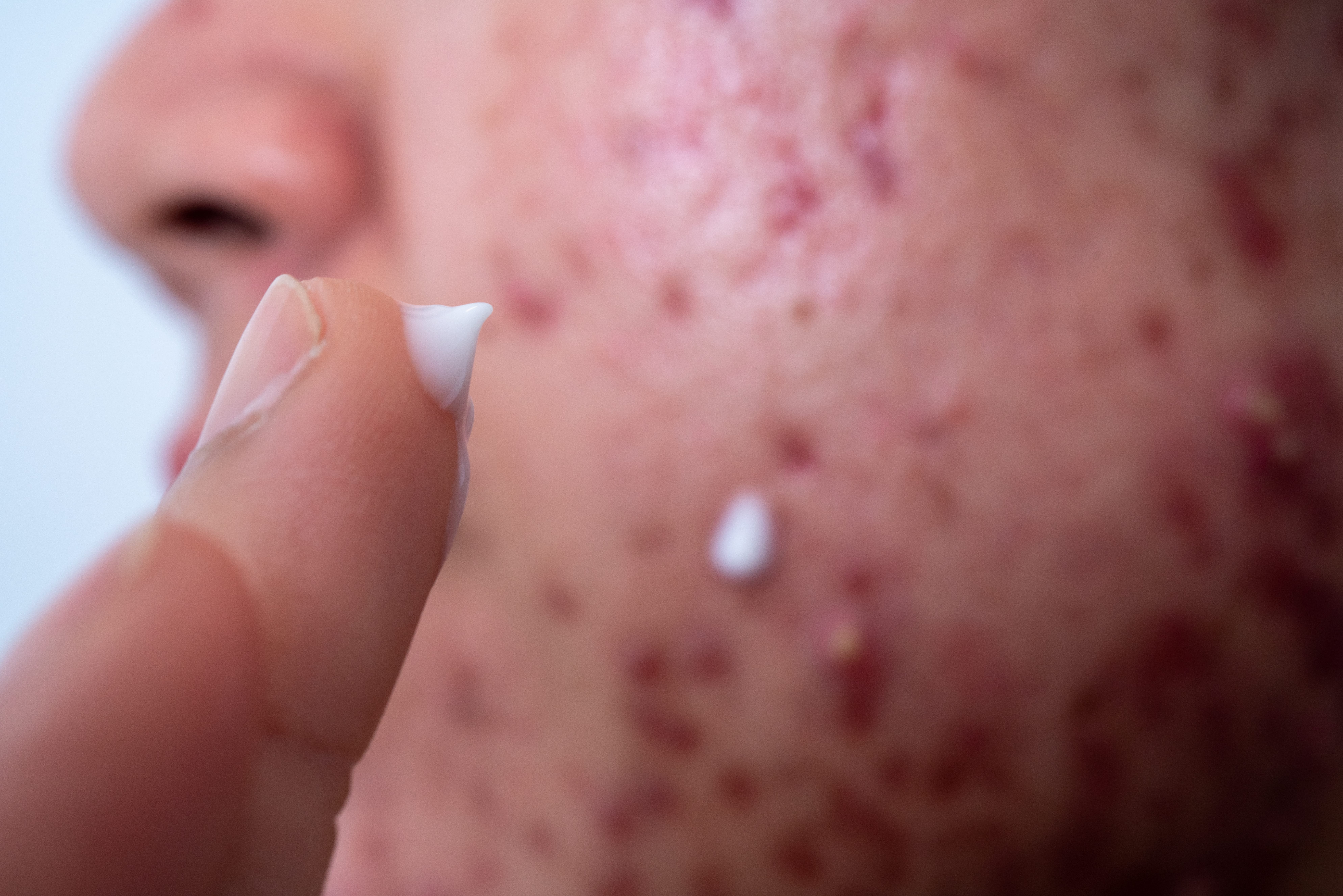 Acne on face close-up